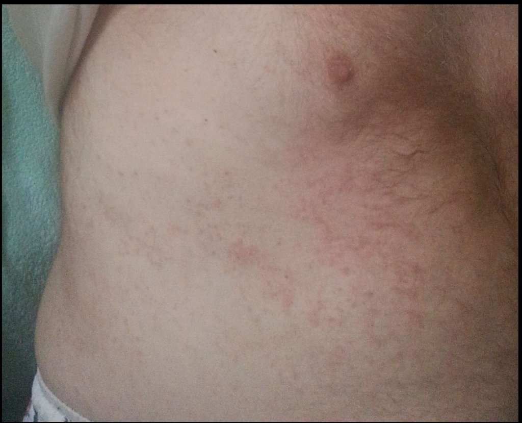rash_1.jpg