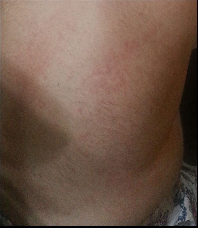 rash_2.jpg