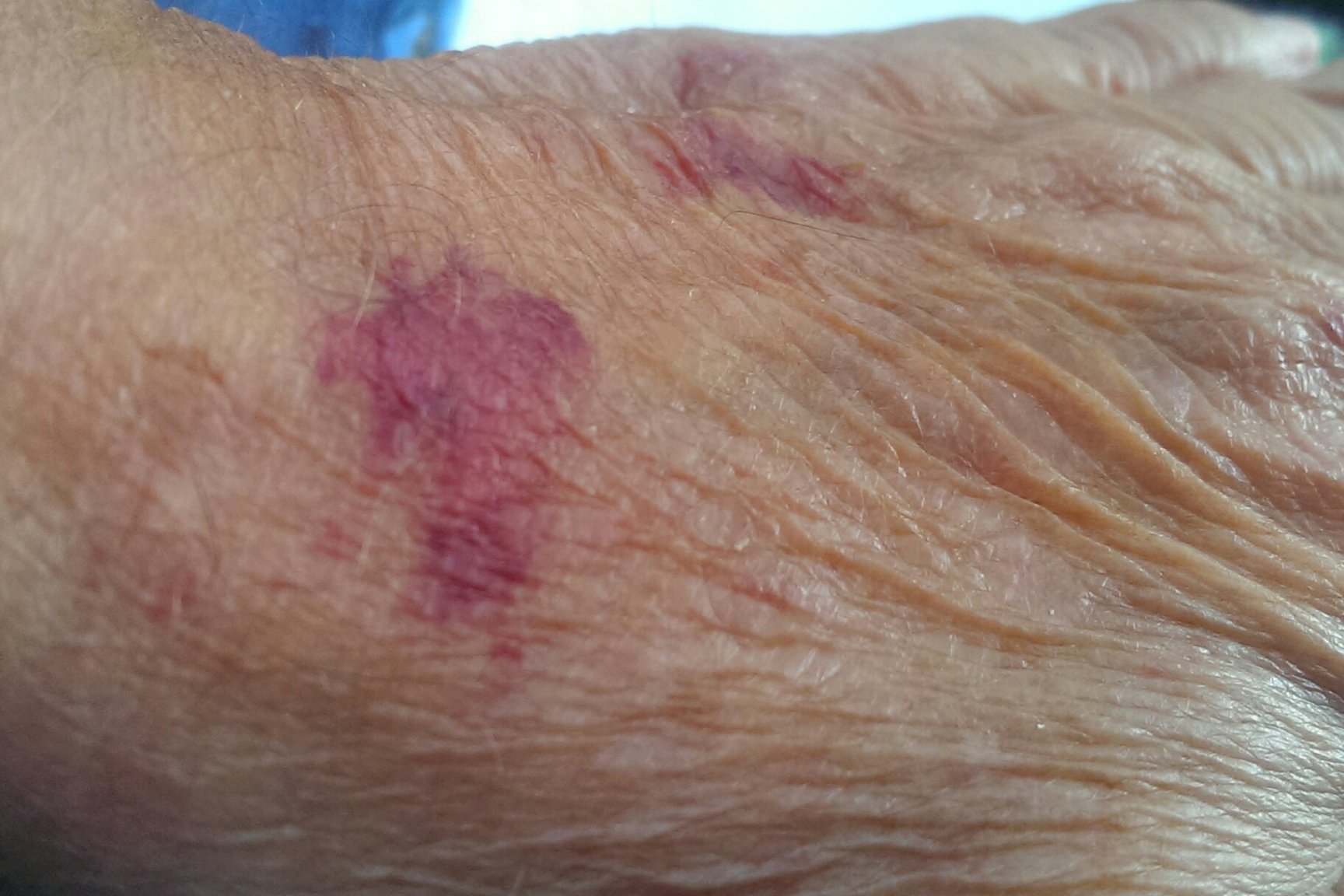 SKIN SPOTS.jpg