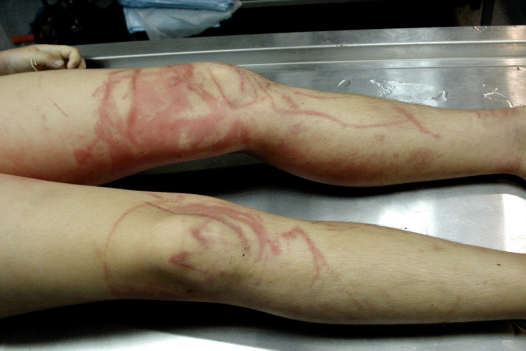 jellyfishstinglegs-1024x683.jpg.7f1ff499b2351234e2166ed4e3da2183.jpg