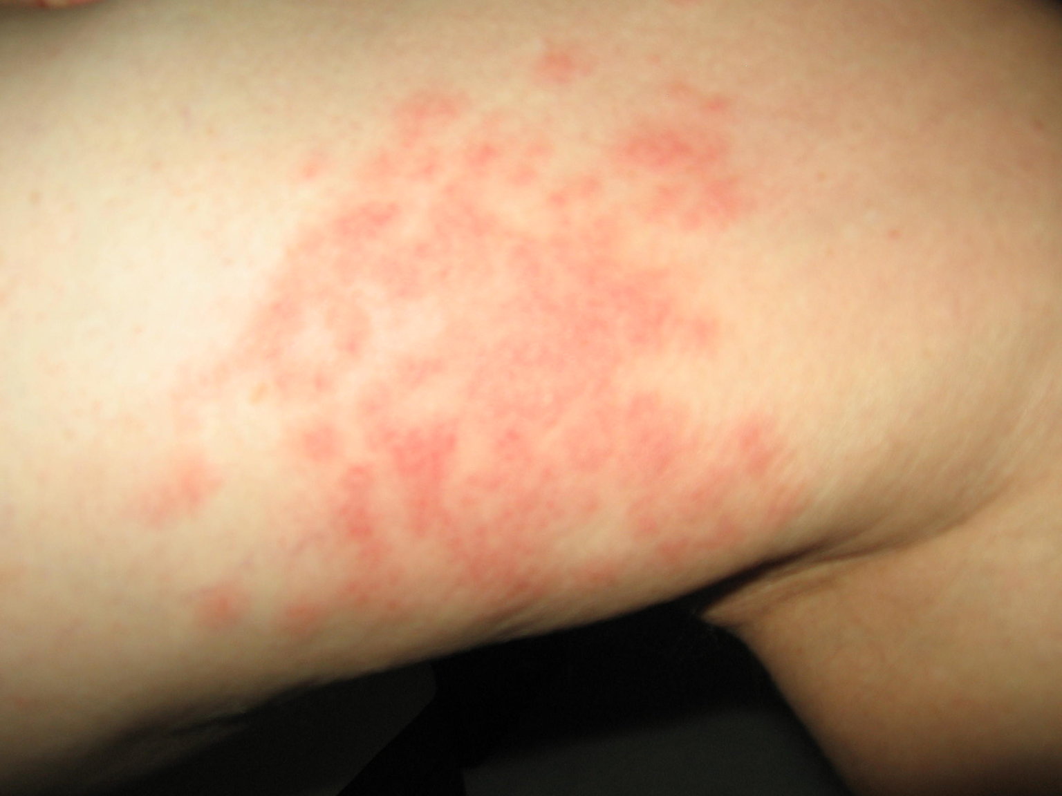 jellyfish stings 014.JPG