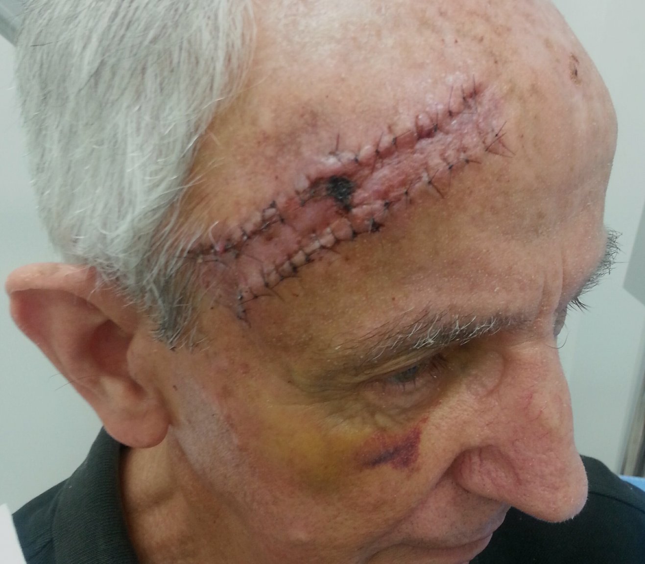 5a9a4c24ad0fa_Flapsurgery.thumb.jpg.daca31c8a24fa51389ee190381ffbc6b.jpg
