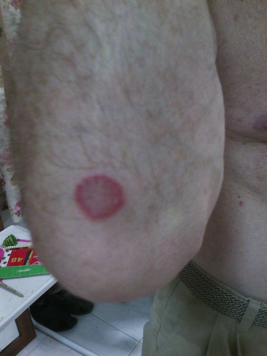 Elbow Rash Bite.jpg