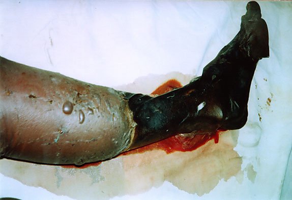 snake-bites-4.jpg.f13e799c255e7e69c2647872b8d0f09f.jpg
