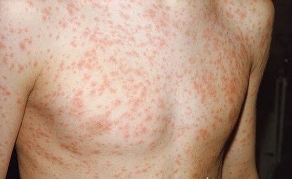 travellers-advised-to-get-vaccinated-before-going-to-thailand-due-to-measles-outbreak-world-of-buzz-2.jpg