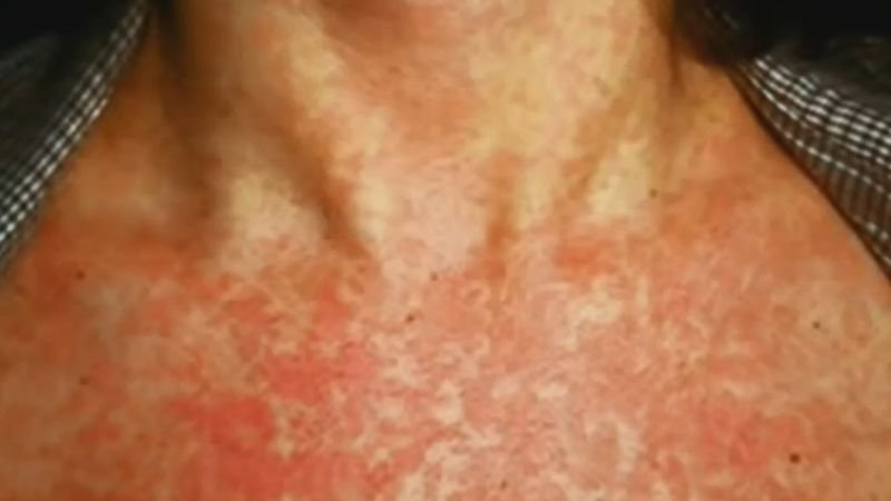 http___prod.static9.net.au___media_2018_12_29_15_51_measles.jpg