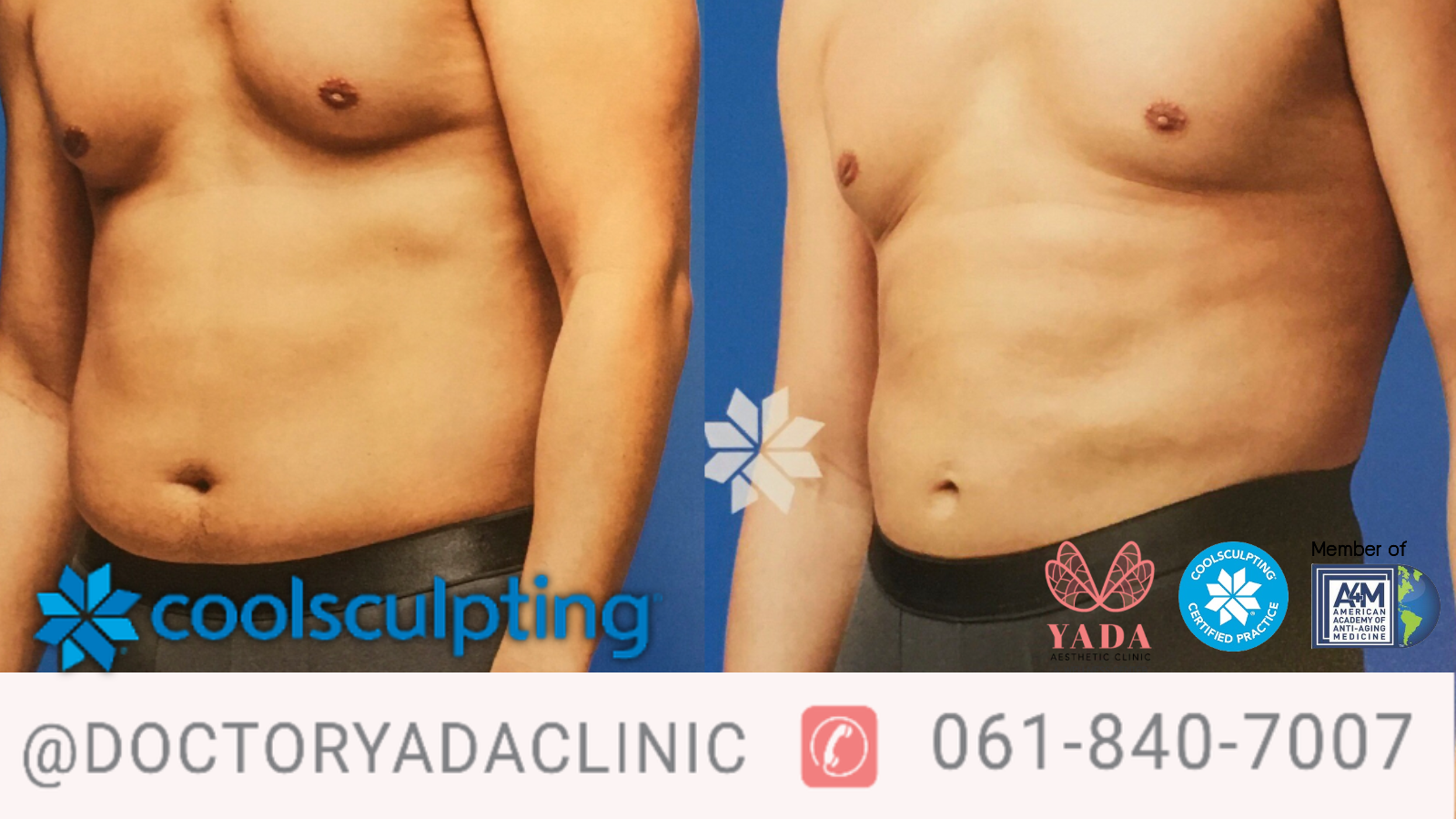 CoolSculpting Fat Body Shape Doctor Yada Clinic Pattaya.png