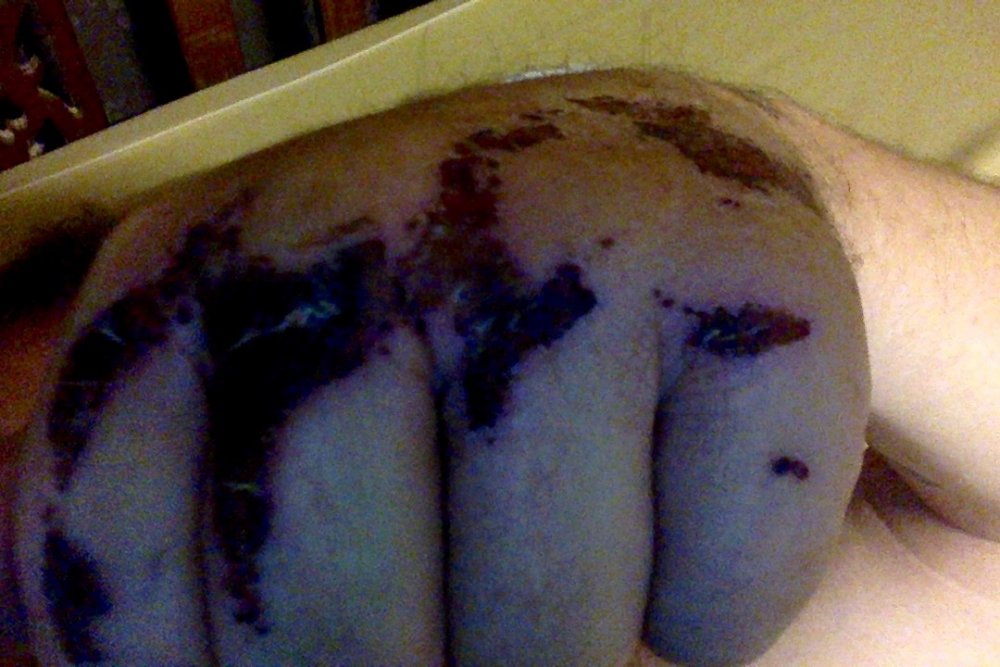 barked knuckles.jpg