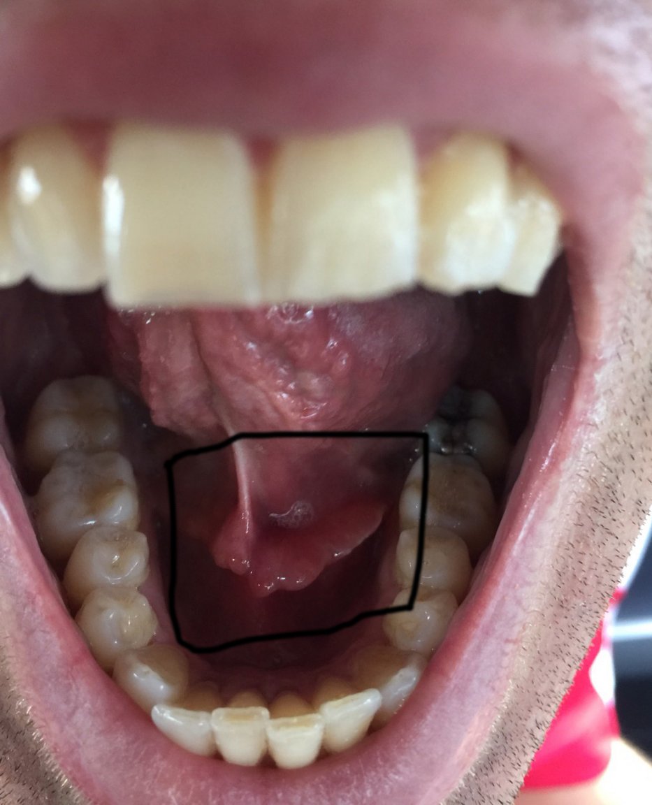 infected mouth.jpg
