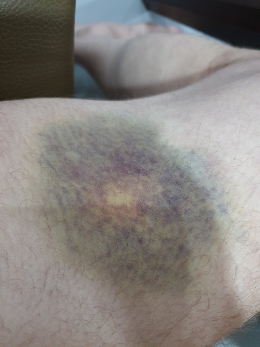 Bruise.jpg