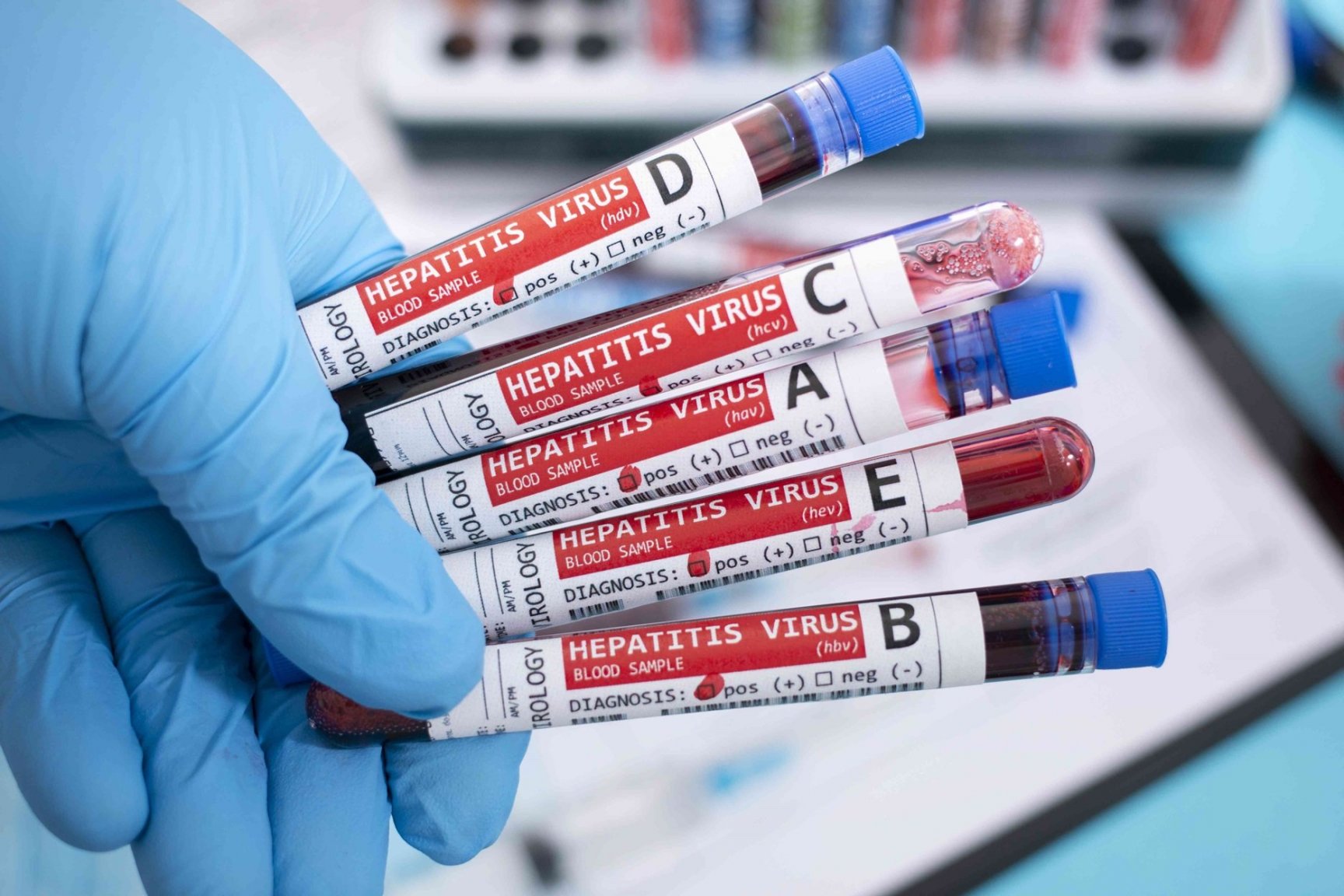 hepatitiscauses-GettyImages-1218549527-01a5d5457f00422394b6c52bf813cb27.jpg