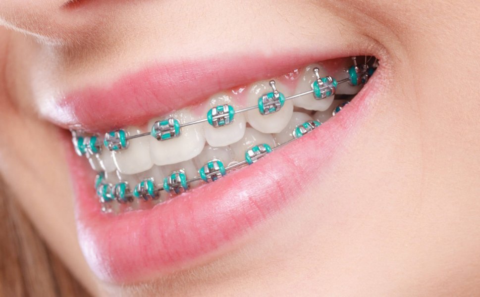 rubber-bands-for-braces-scaled-1.jpg