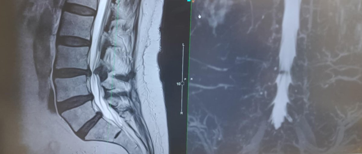 MRI scan back problem.jpg