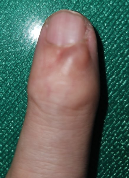Cyst.jpg
