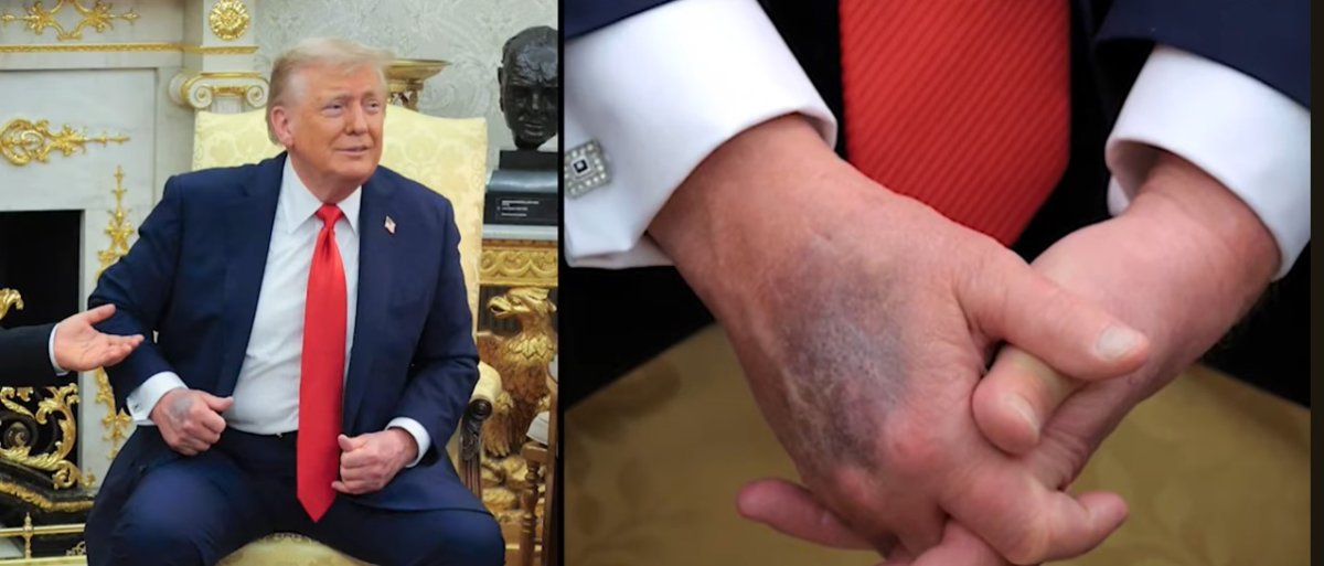 Trump Bruised Hand.jpg