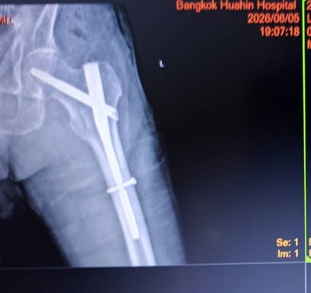 Ankle Fusion?