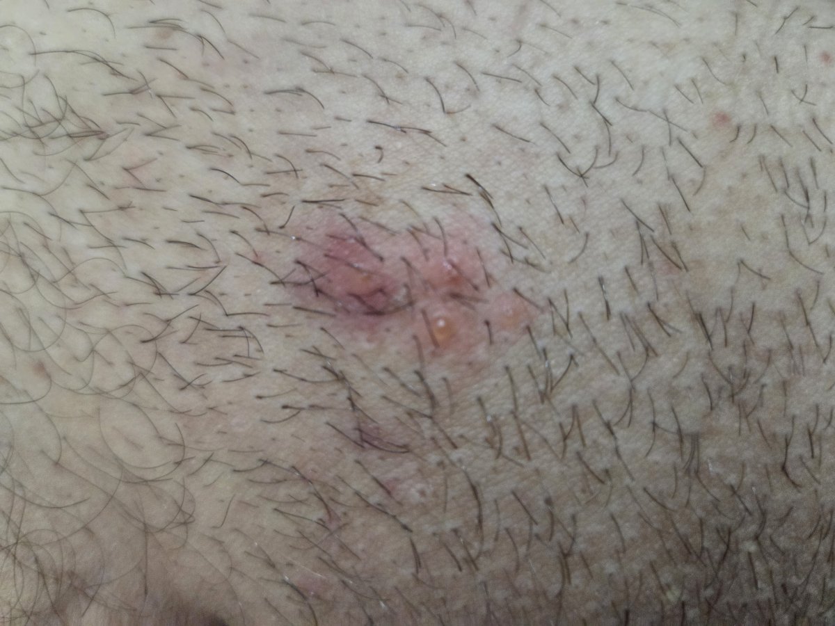 Pimple things on public hair region. What could it be?