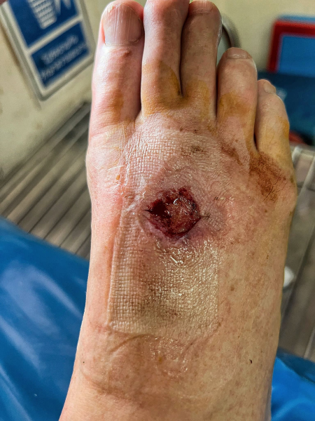 Mosquito Bites