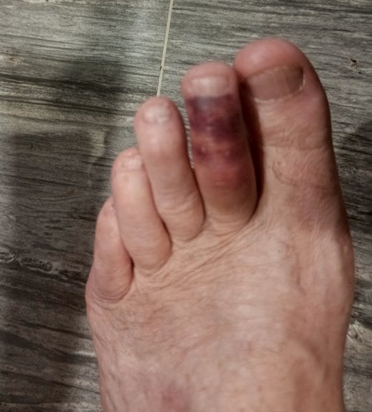 Purple toe